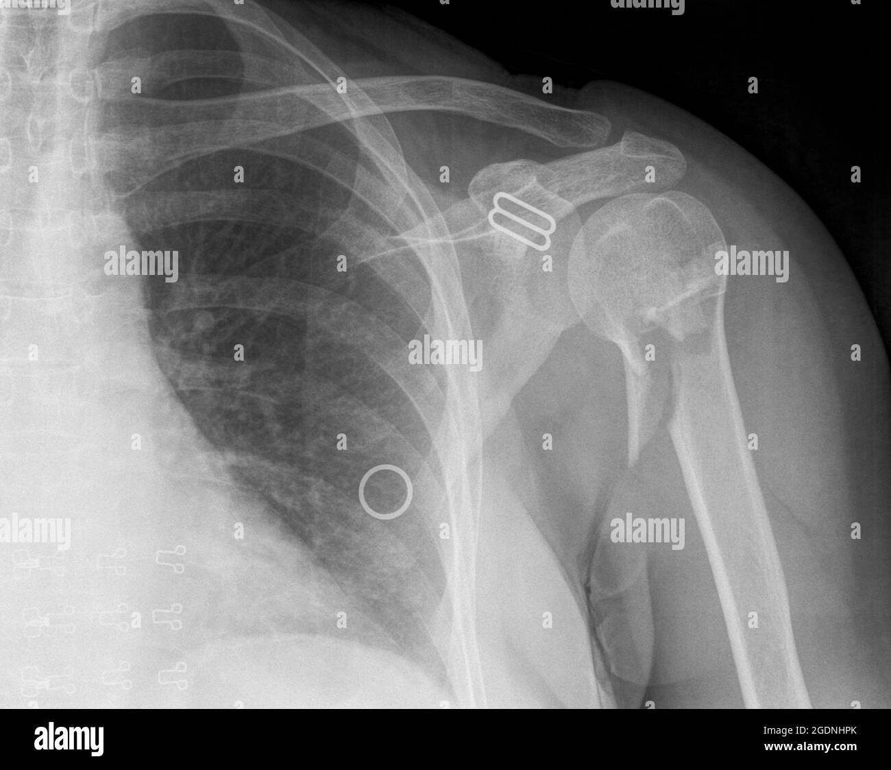 fracture of the Humerus bone after surgery 64 year old female Stock Photo