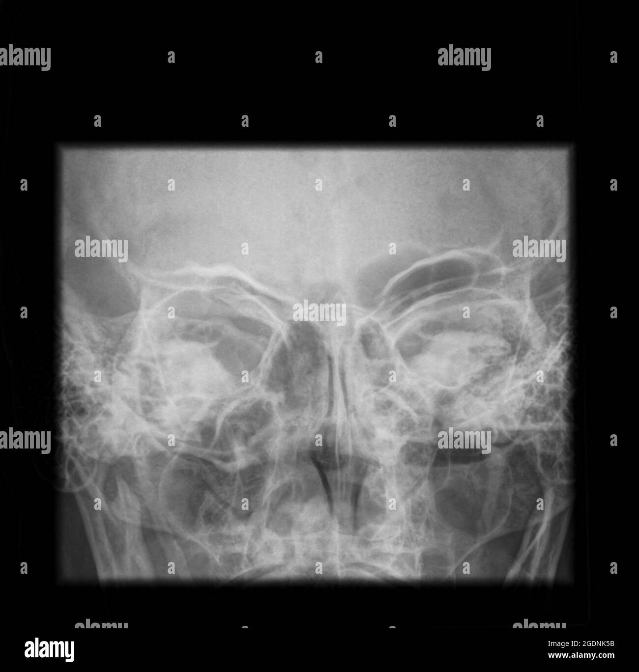 A 65 year old male suffering from Sinusitis. X-ray of the paranasal sinuses Stock Photo