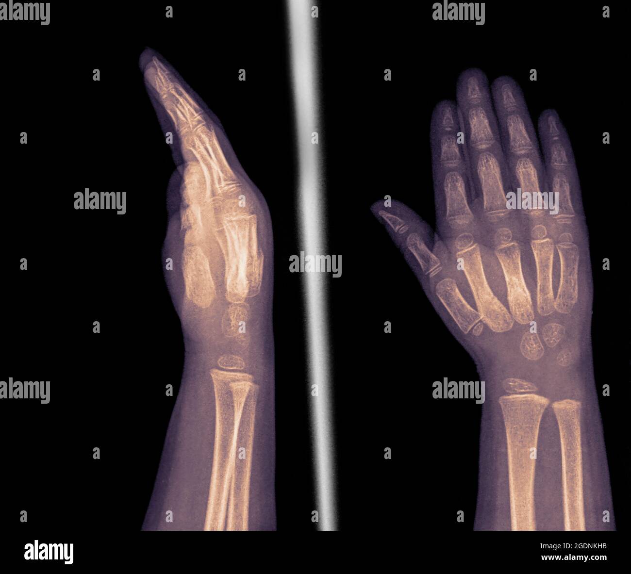 x-ray of the wrist and hand of a 2 year old female patient showing 2 and 3 metacarpal fractures Stock Photo