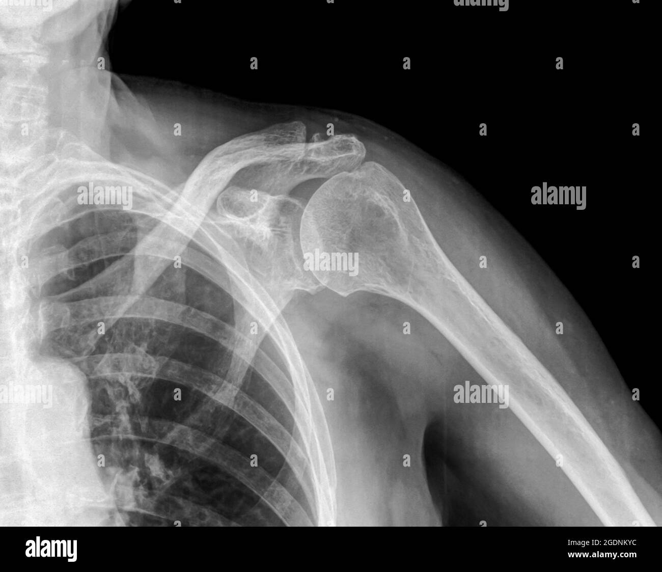 X-ray of a left shoulder of an 89 year old male patient Stock Photo