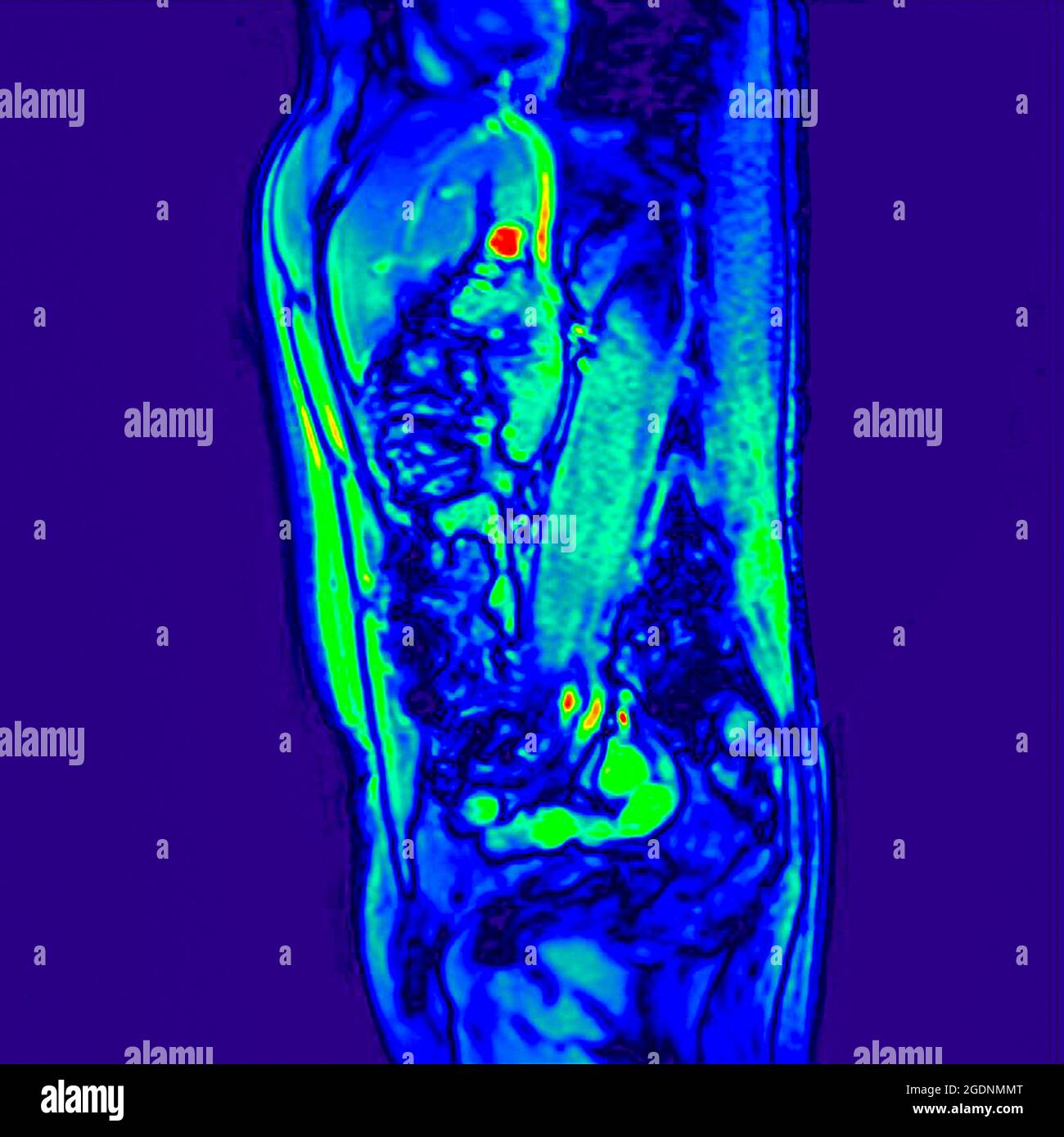 Side view Abdomen MRI scan of a 60 year old male patient. This patient suffers from a kidney stone Stock Photo