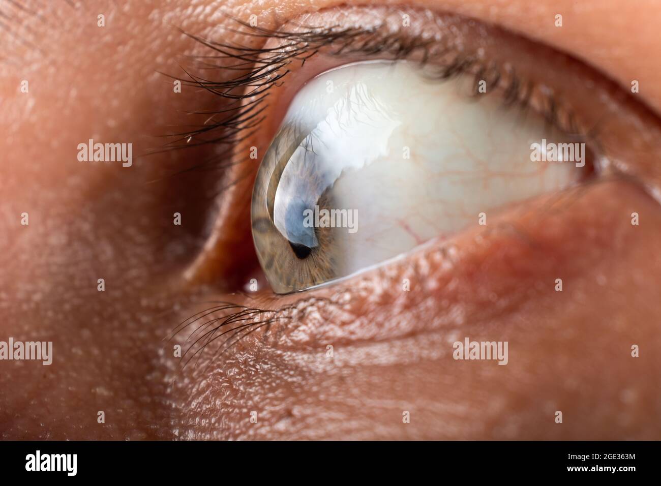 eye with corneal dystrophy closeup, keratoconus disease thinning of the cornea. Stock Photo