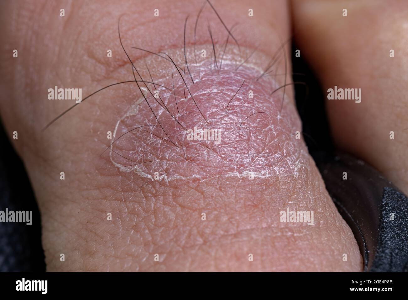 Infected Ingrown Hair Pictures Treatment Removal and More