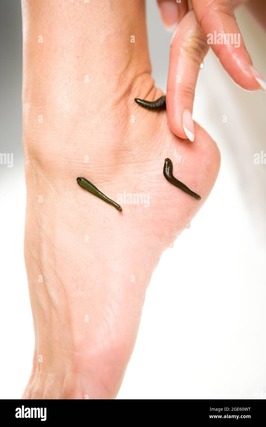 Leech therapy hires stock photography and images Alamy