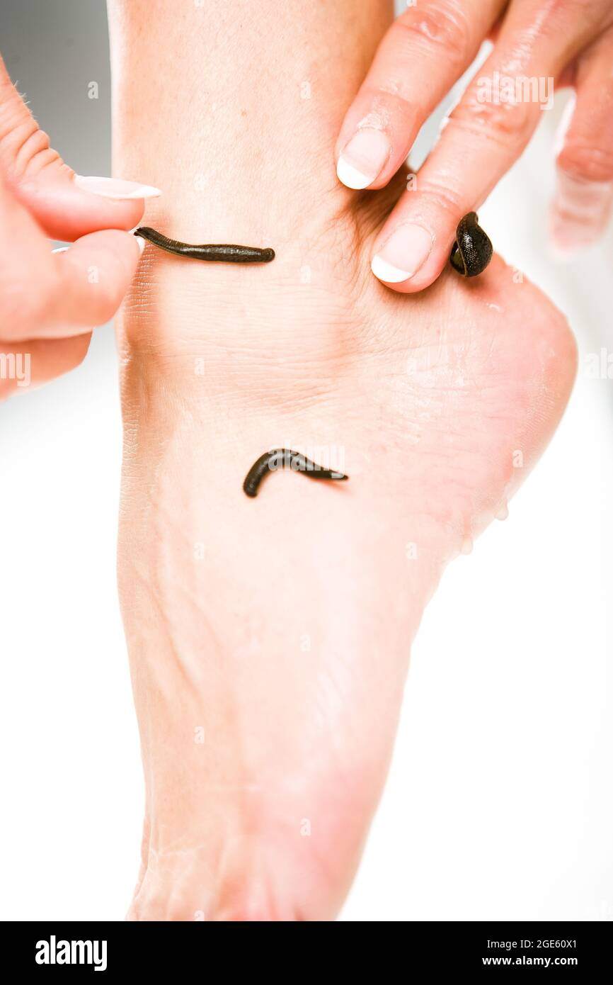 Leech Therapy Finger Leech Therapy Finger