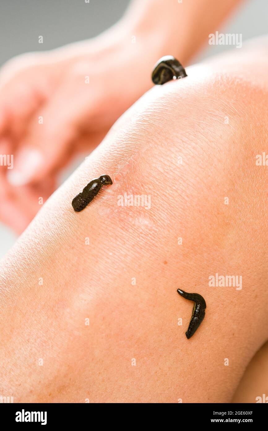 Leech therapy hi-res stock photography and images - Alamy