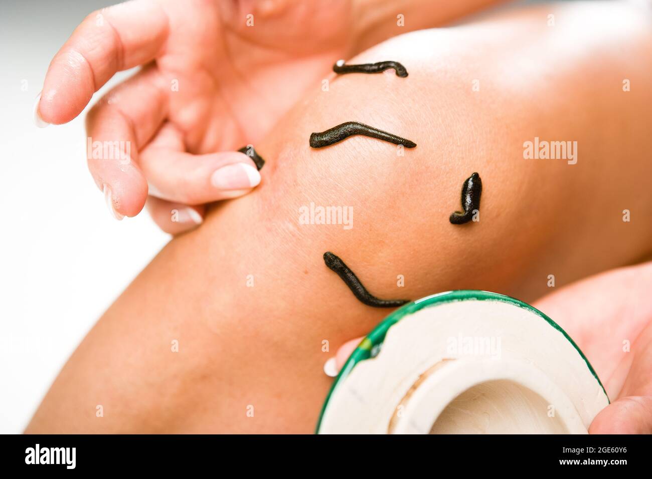 Leech therapy with medical leeches on human body. Naturopathy, health, natural medicine, good blood circulation. Stock Photo