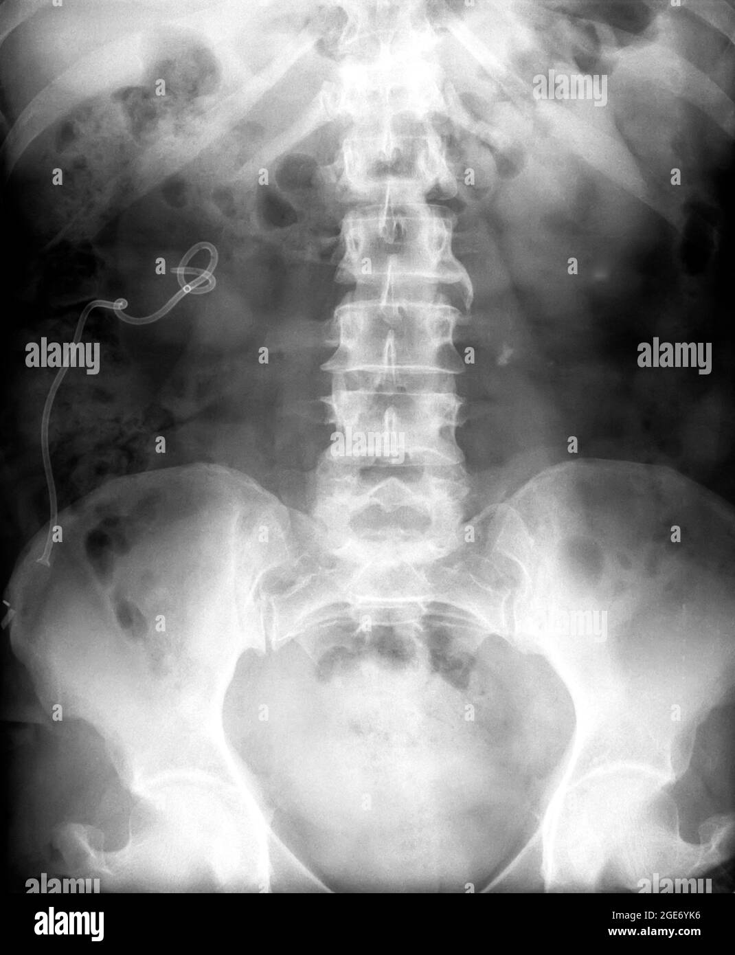X-ray of an abdominal of a 50 year old female patient Stock Photo