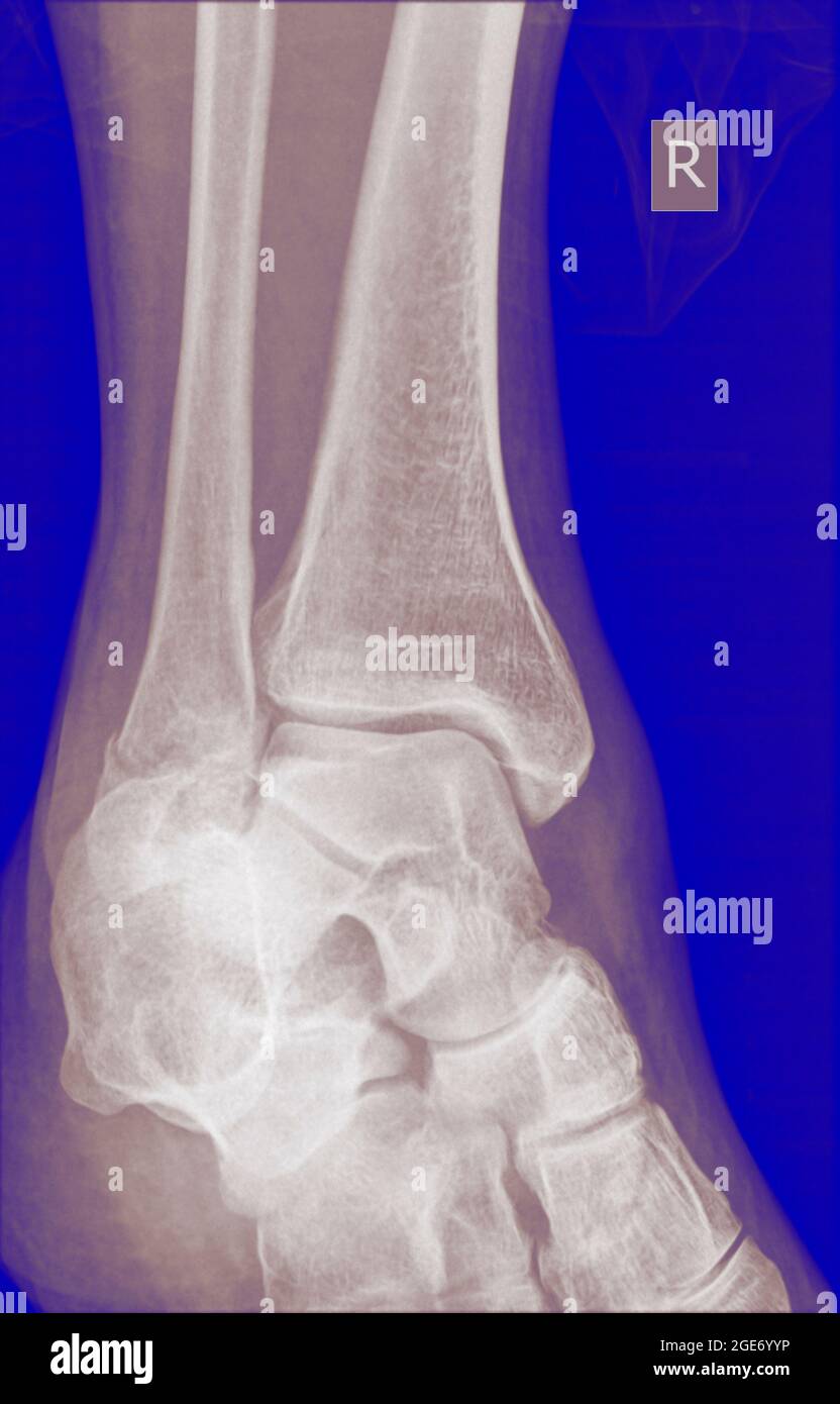 X-ray of a 43 year old male patient with a fracture in the distal radius Stock Photo