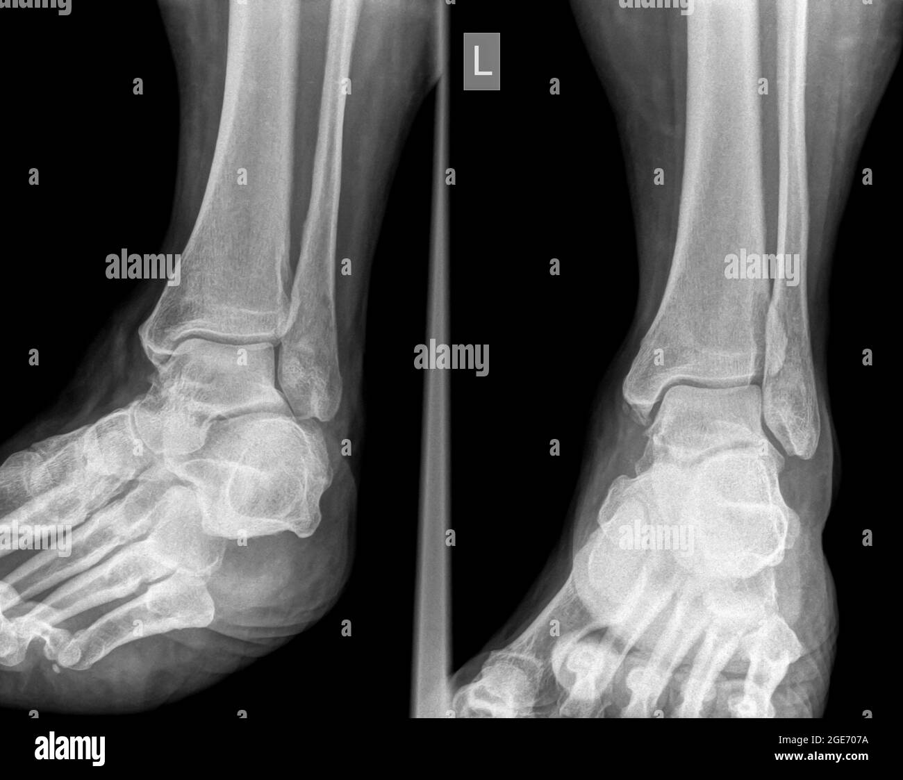 X-ray of an ankle 50 year old male with a fractured distal tibia. front View Stock Photo