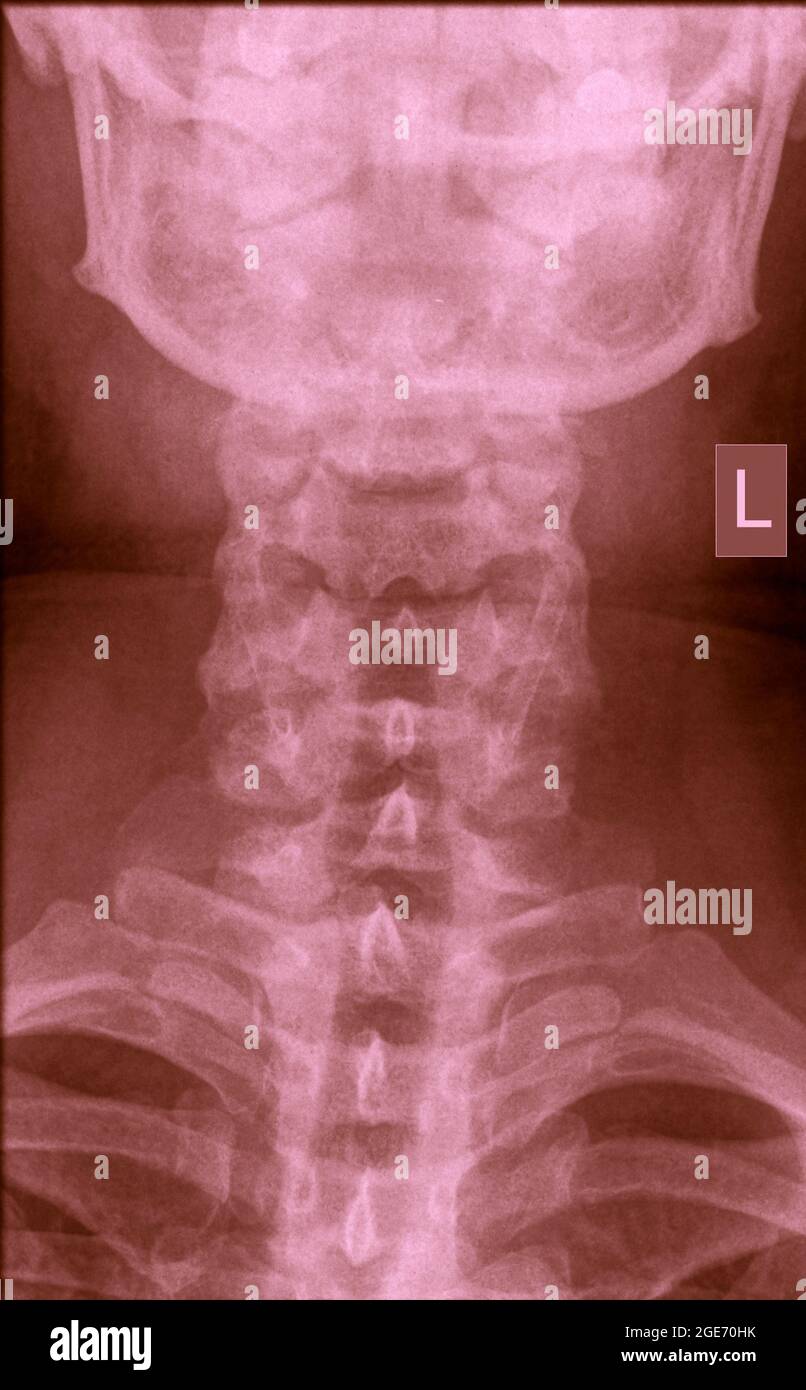 Cervical spine hi-res stock photography and images - Alamy