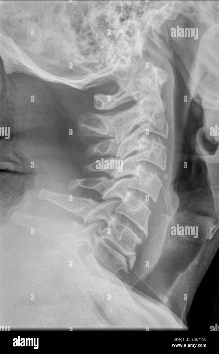 Cervical spine x-ray with a fractured Dens. A 50 year old male patient side View Stock Photo