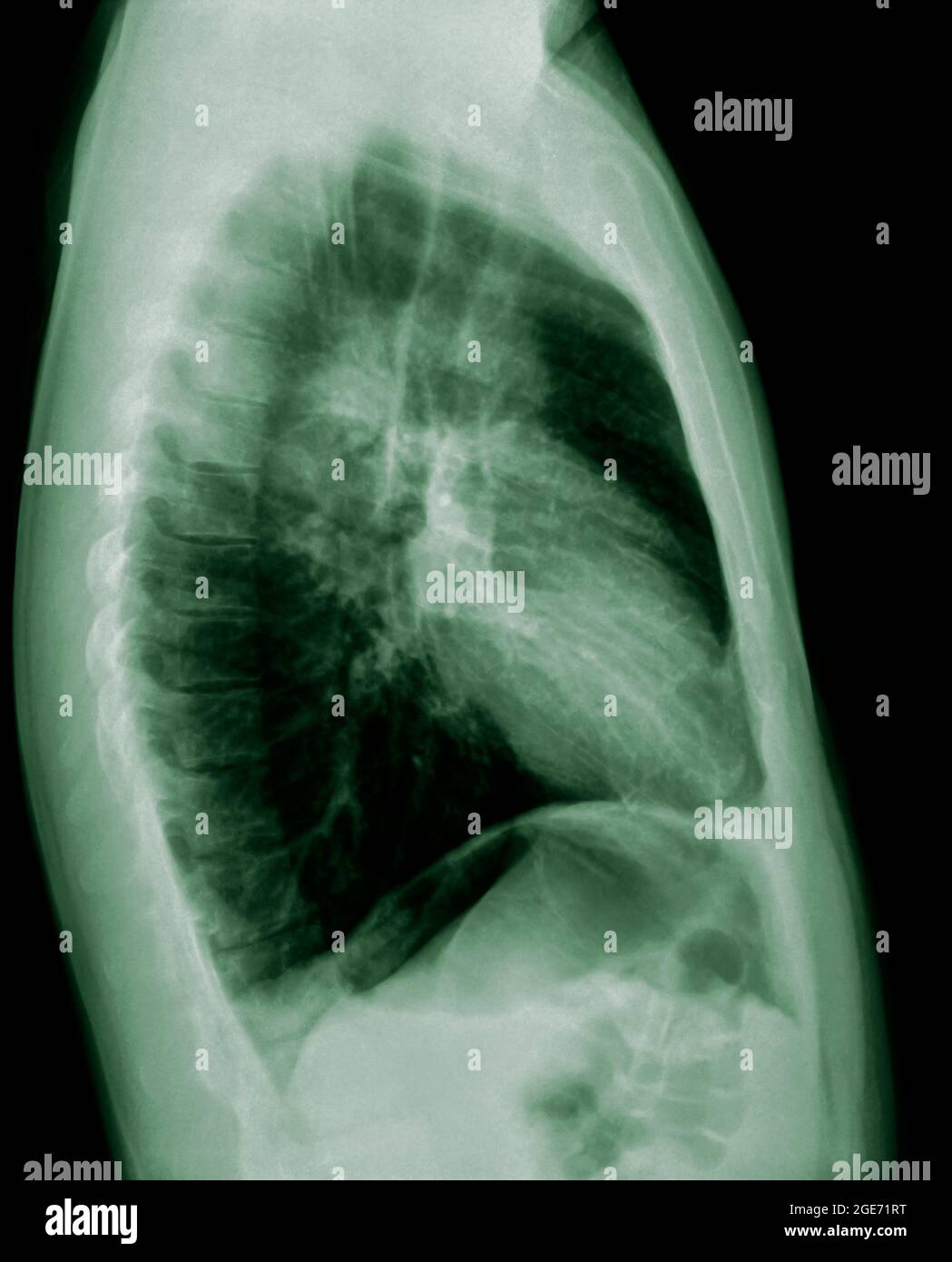 Normal Healthy Chest xray of a 36 year old male. side view Stock Photo Alamy