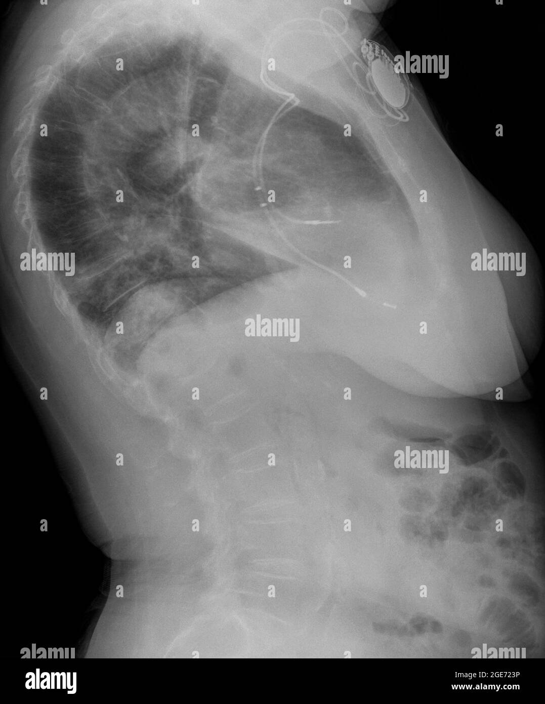 chest x-ray of an 82 year old female patient with a pace maker Stock Photo