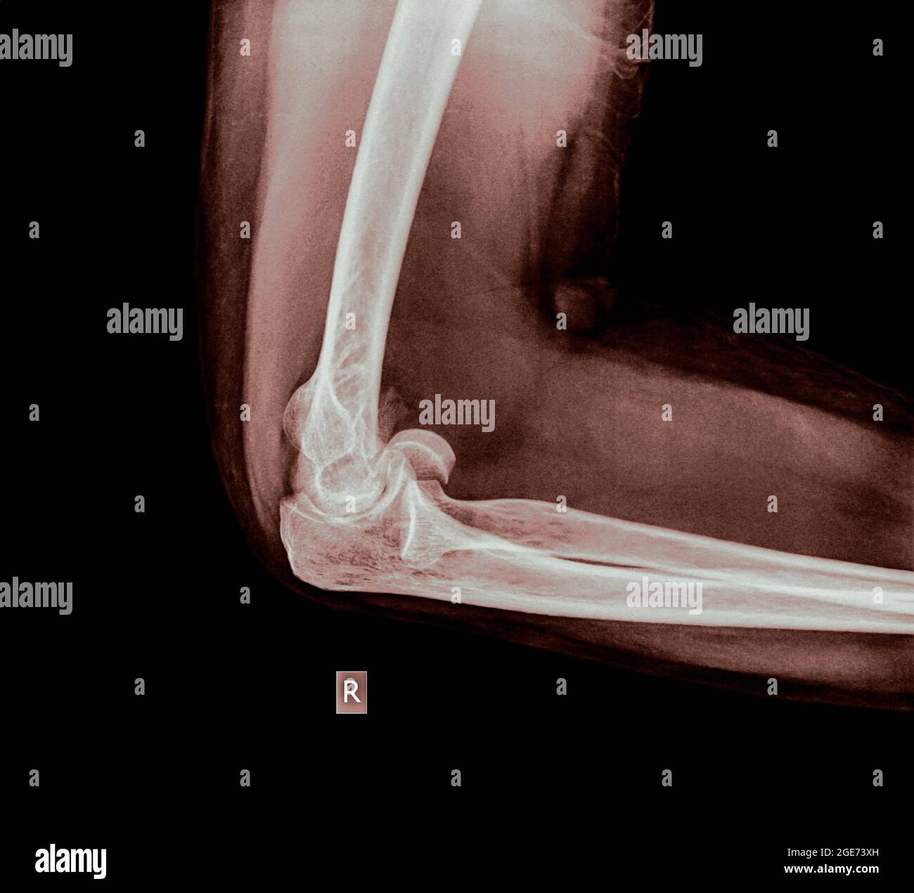 X ray of a fractured elbow (Humerus bone) of a 70 year old female patient Side view Stock Photo