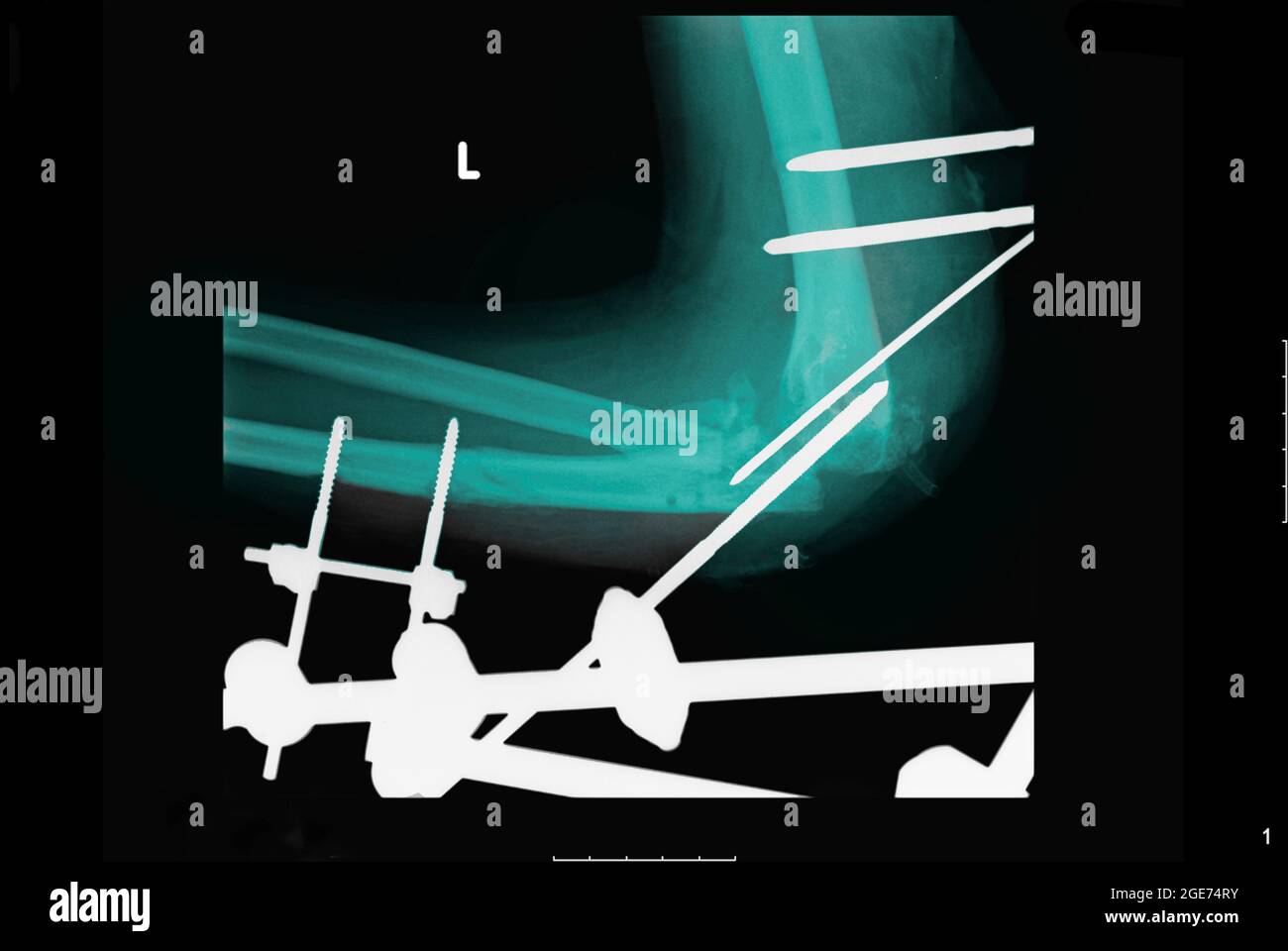 X-ray showing metal fixtures inserted to fix a multiple fracture in the arm Stock Photo