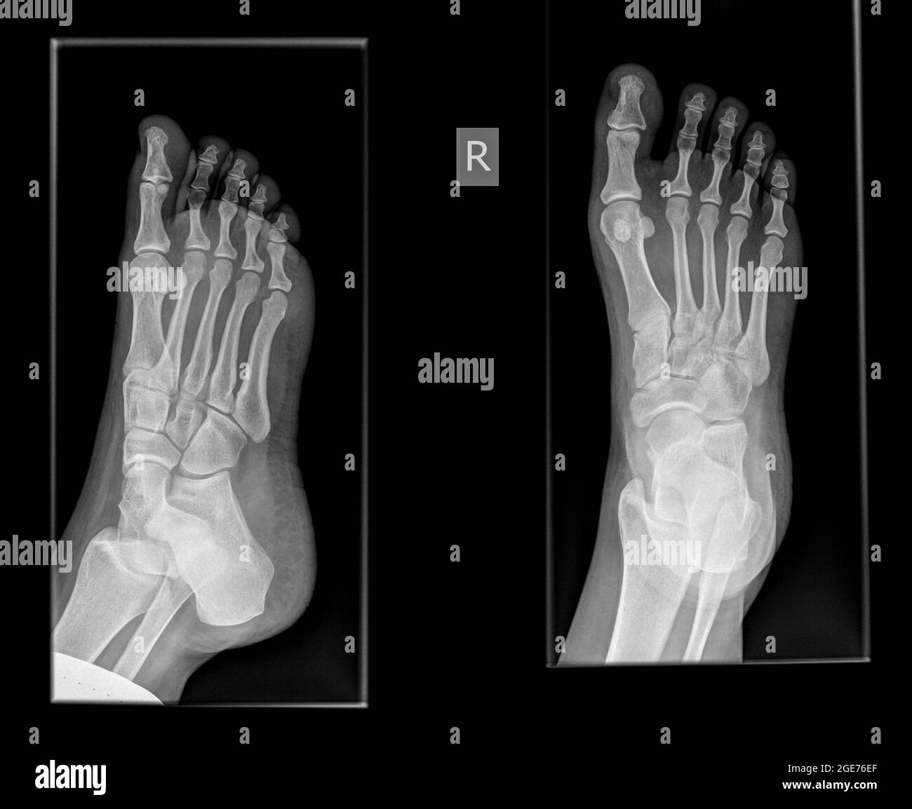 x-ray of a foot showing a fracture in the proximal phalanx of the big toe on the righ foot of a 30 year old female patient Stock Photo