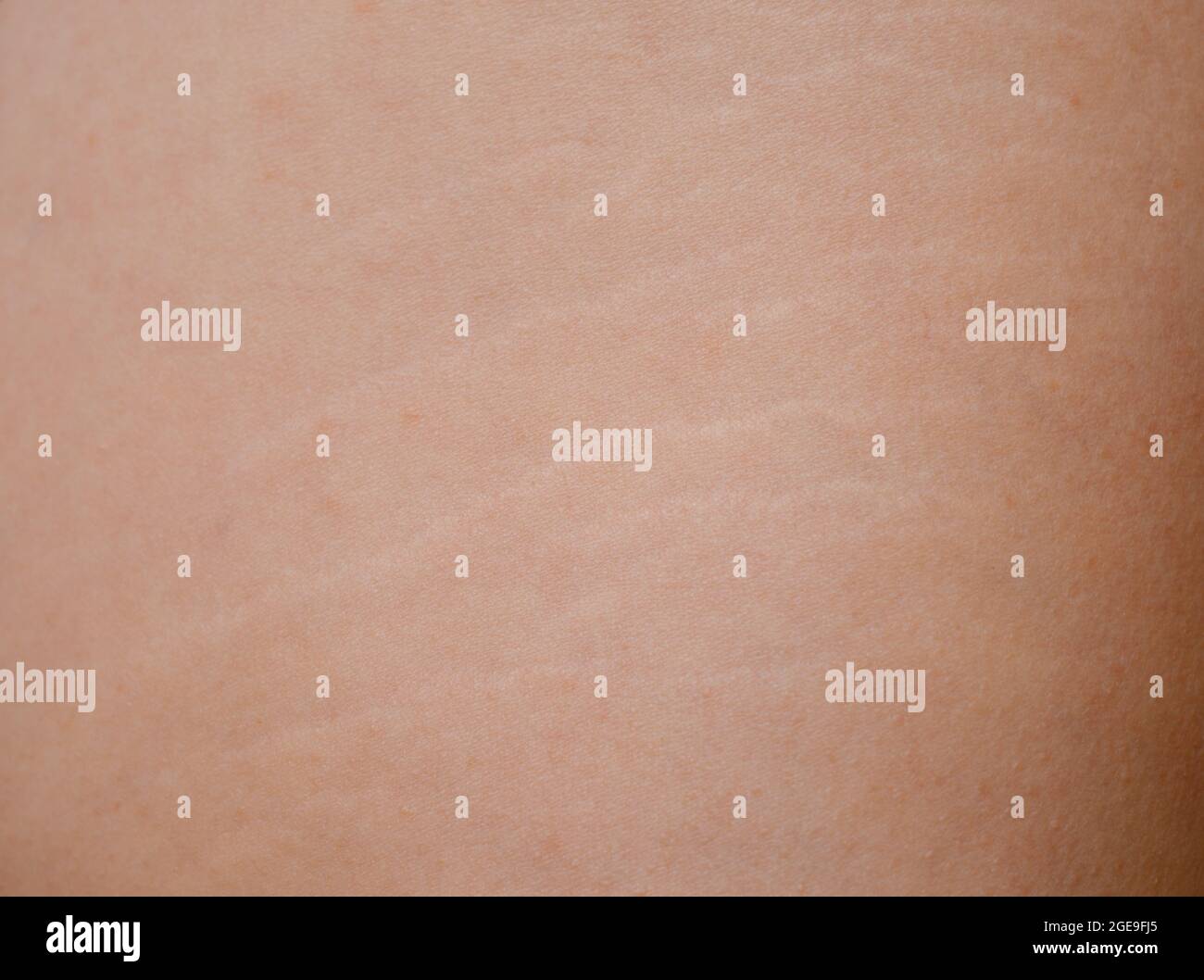 Close-up of stretch marks on the thigh and the texture of human skin. Stock Photo