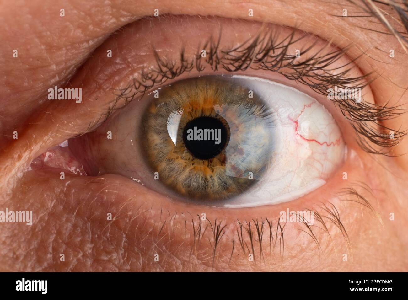 an elderly man eye closeup, eye with diagnosed keratoconus corneal thinning. Stock Photo