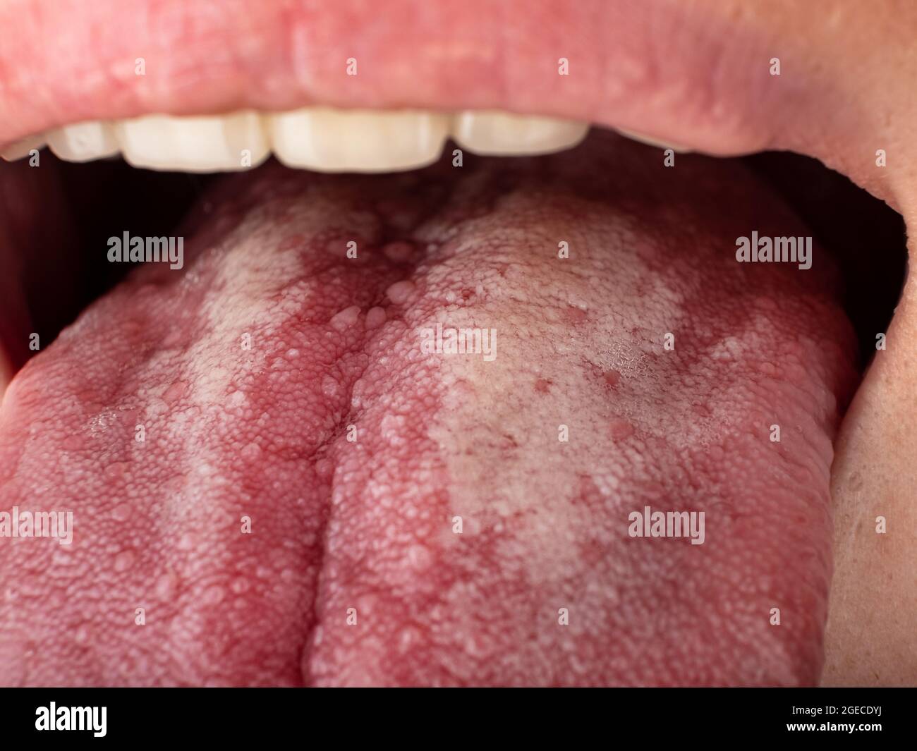 tongue with stomatitis close up, oral cancer. Stock Photo