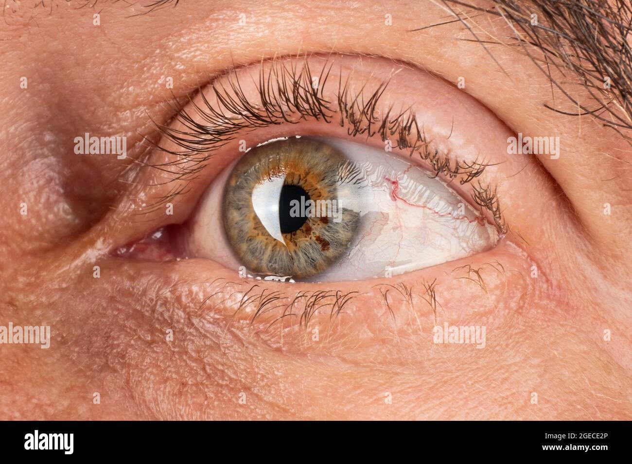 elderly person eyes thinning of the cornea, keratoconus corneal dystrophy closeup. Stock Photo
