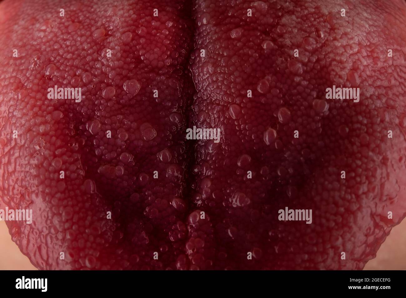 tongue with stomatitis close up, oral cancer. Stock Photo