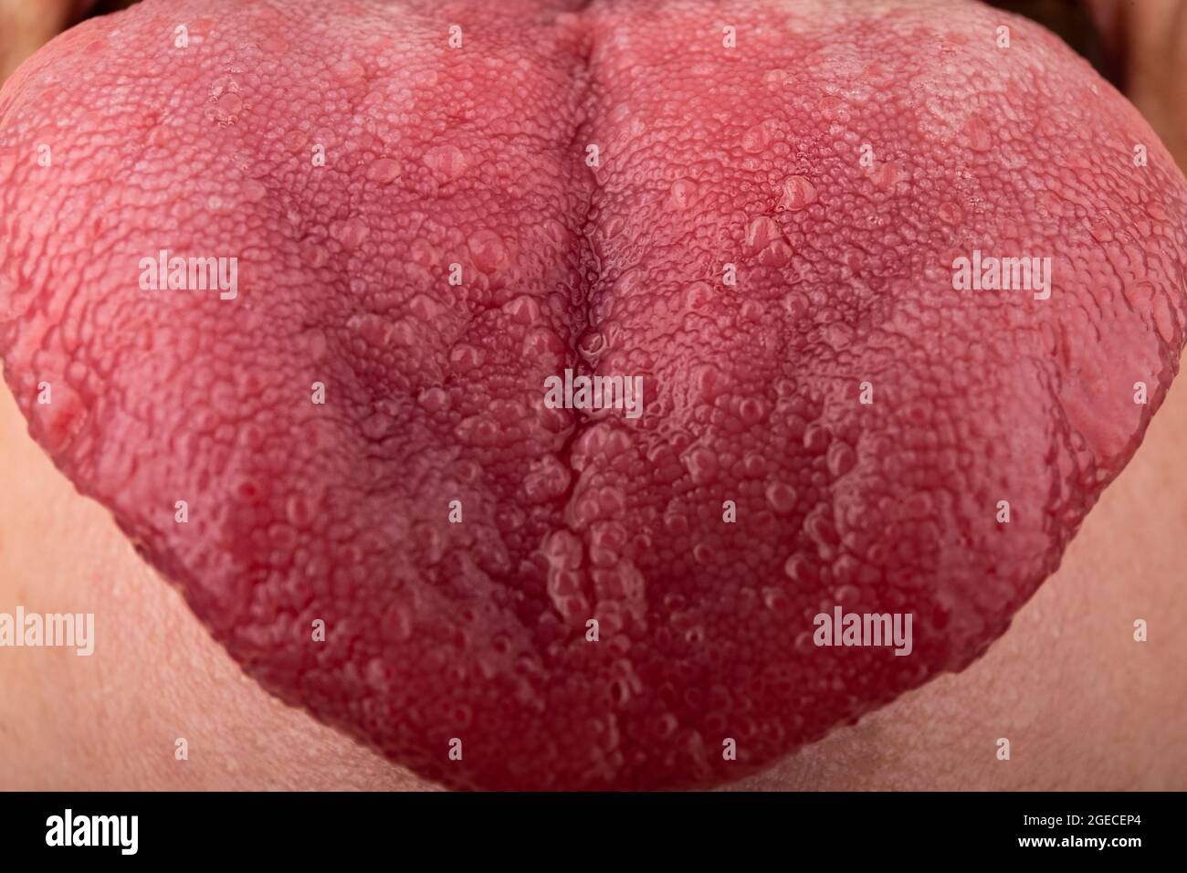 cracks in the tongue Candida diseases, red tongue stomatitis closeup. Stock Photo