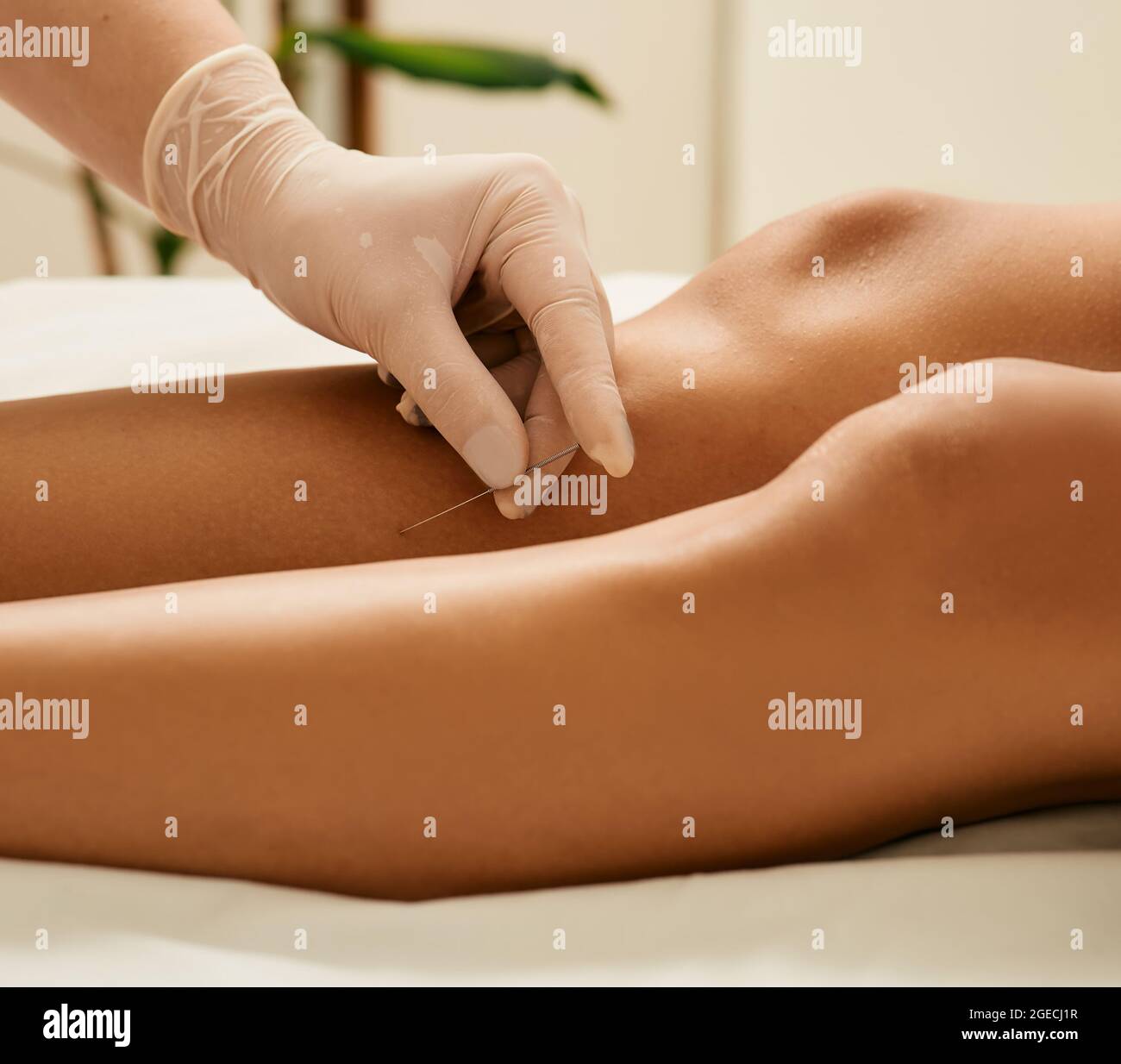 Acupuncture treatment for chronic leg pain. Chiropractor doing acupuncture therapy for female shin with needles Stock Photo