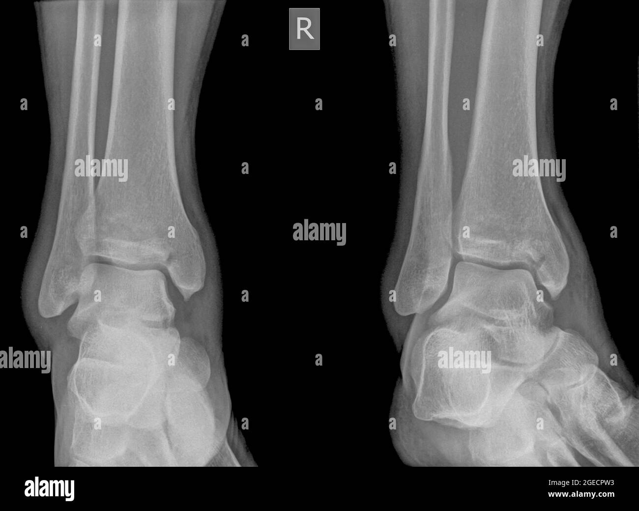 X-ray of an ankle 50 year old male with a fractured tibia. Front view Stock Photo