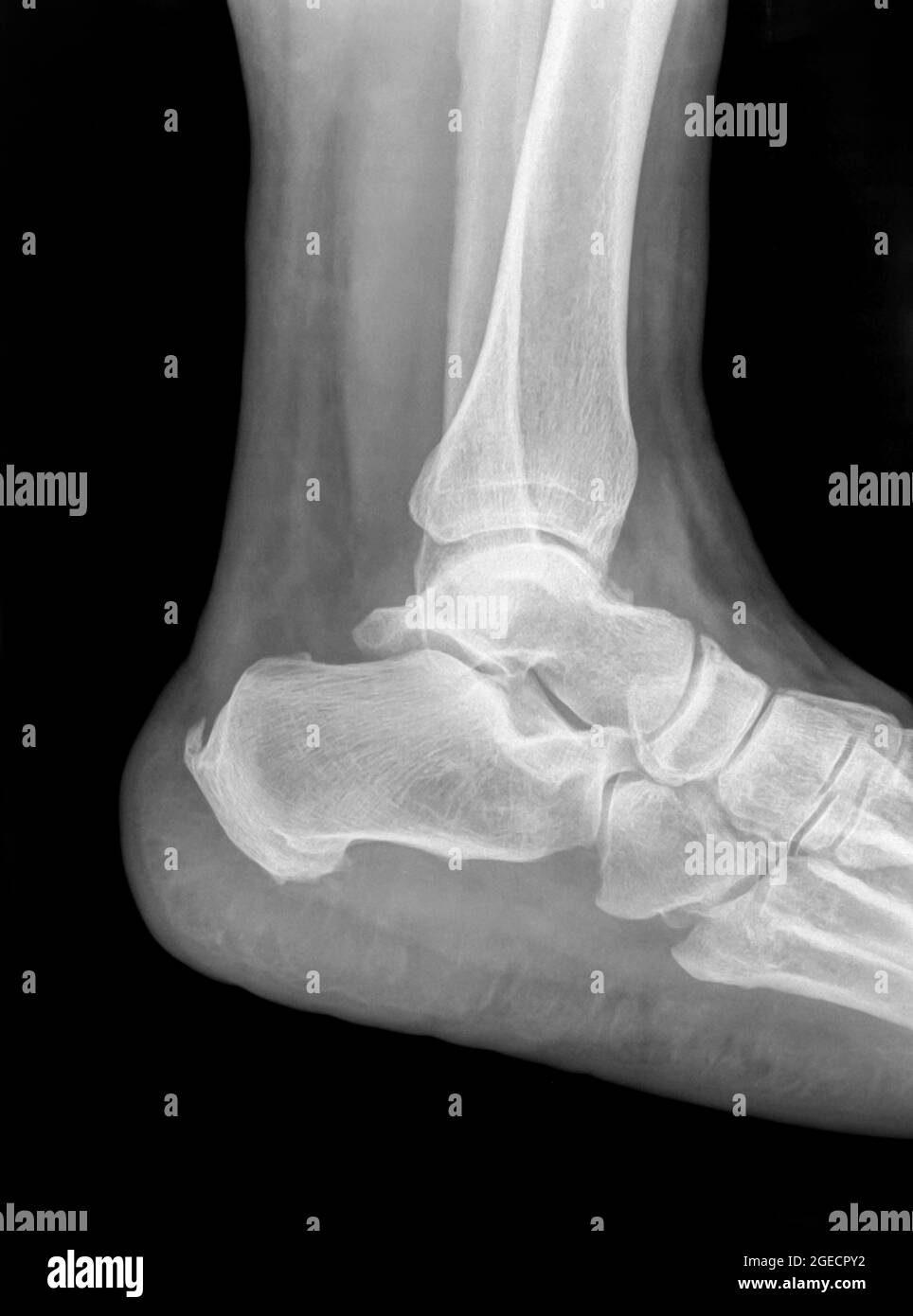 X-ray of an ankle 50 year old male with a fractured distal tibia. Side View Stock Photo