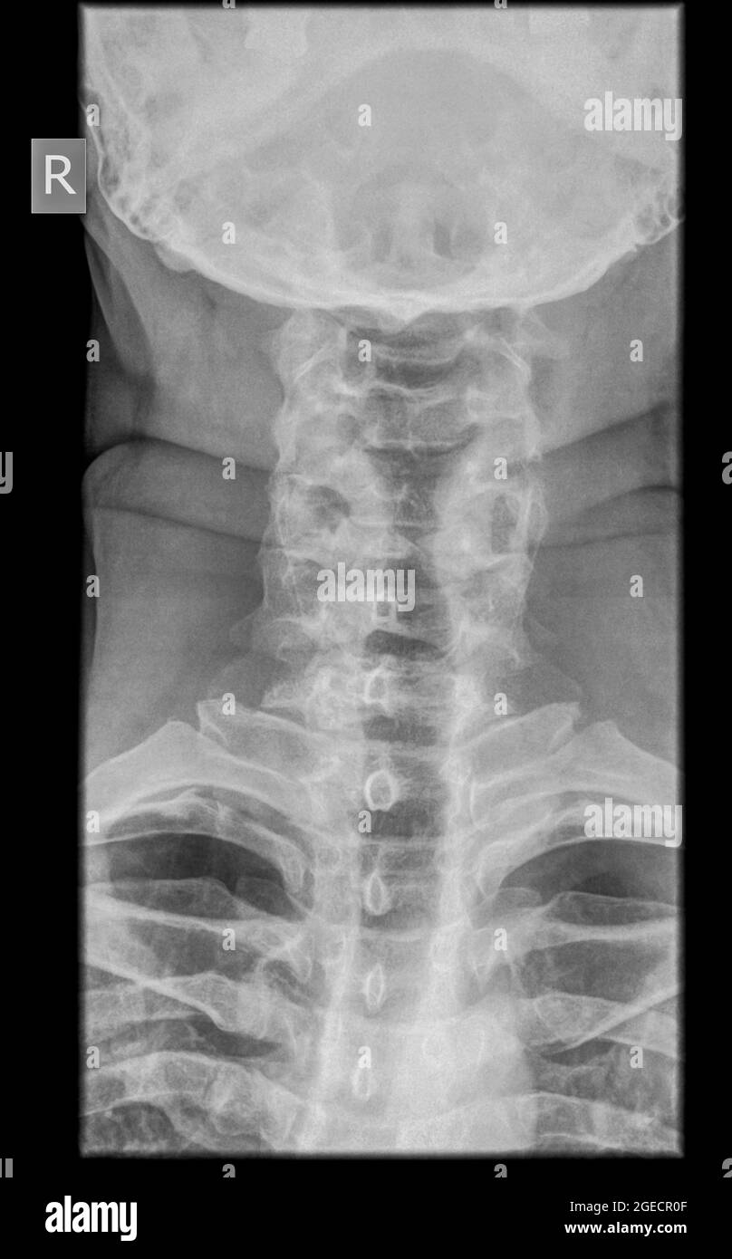 Cervical spine x-ray with a fractured Dens. A 50 year old male patient Front View Stock Photo