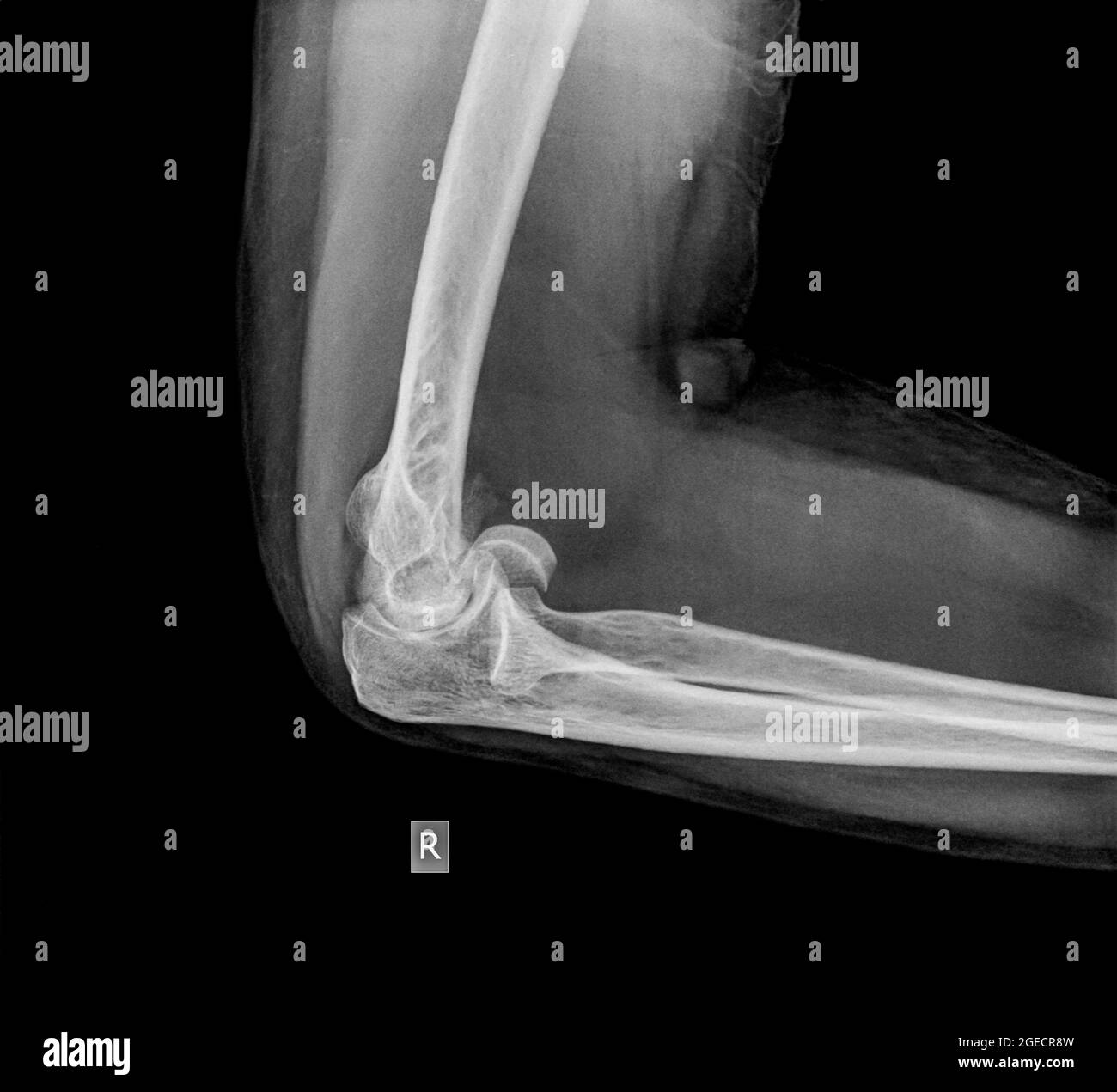 X ray of a fractured elbow (Humerus bone) of a 70 year old female patient Side view Stock Photo