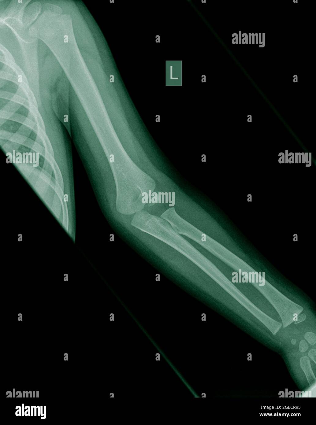 X-ray of a Human forearm with fat pad signs and a Supracondylar humerus fracture on the left arm of a 3 year old male infant Stock Photo