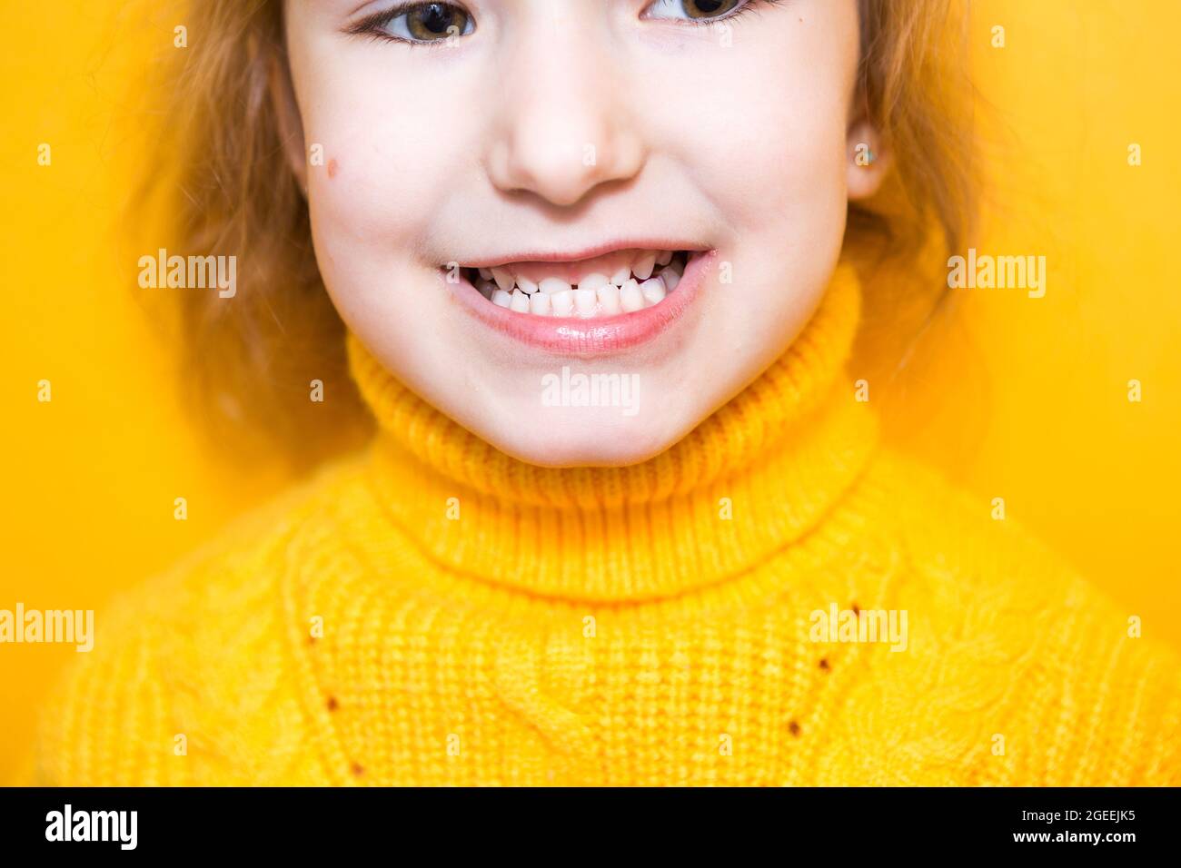 Girl shows her teethpathological bite, malocclusion, overbite