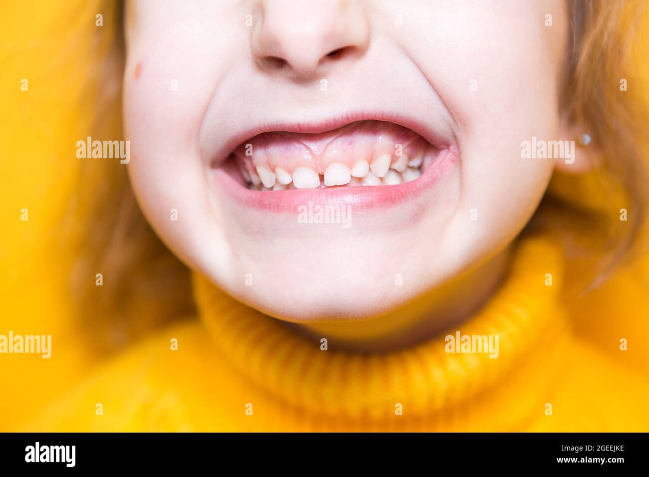 Girl shows her teethpathological bite, malocclusion, overbite