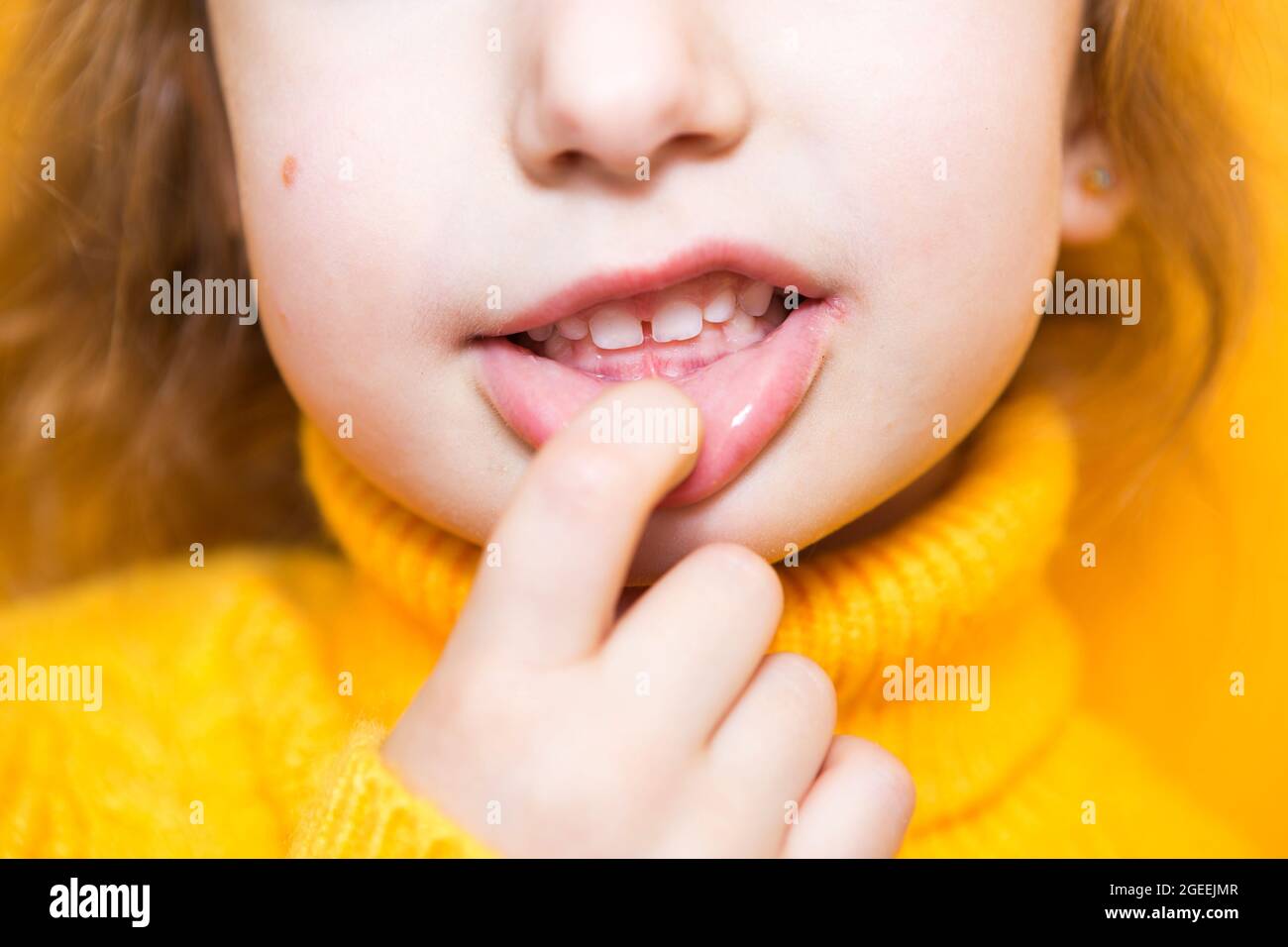 Girl shows her teethpathological bite, malocclusion, overbite
