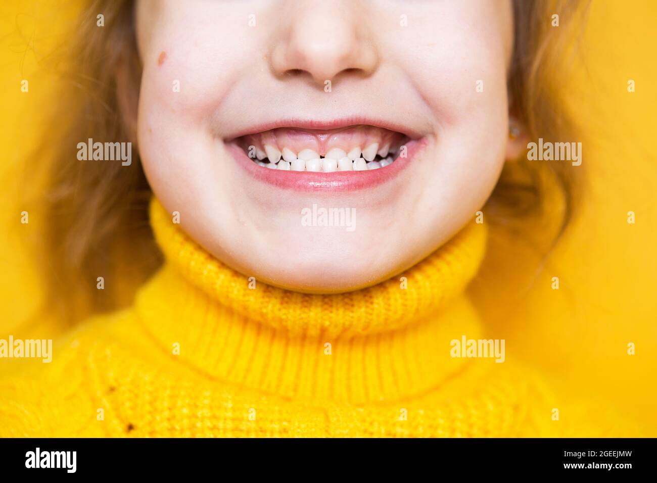 Girl shows her teethpathological bite, malocclusion, overbite