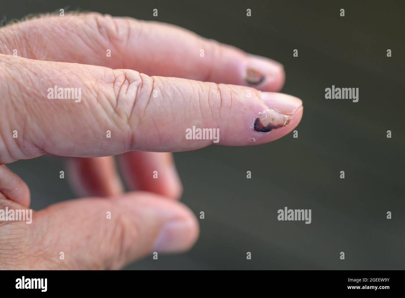Senior man showing healing soft tissue trauma with dead skin and