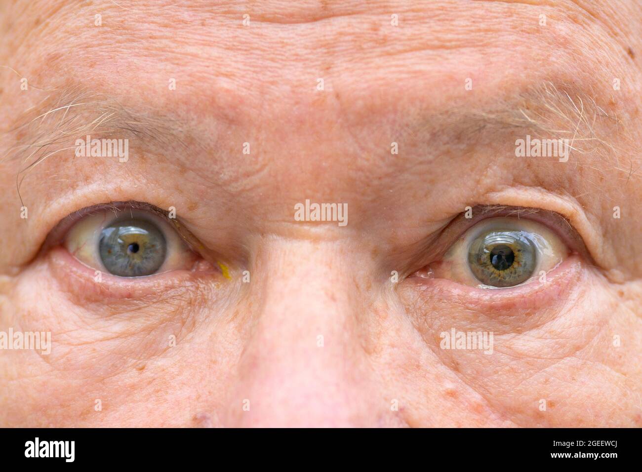 Extreme close up of a senior man with anisocoria showing unequal