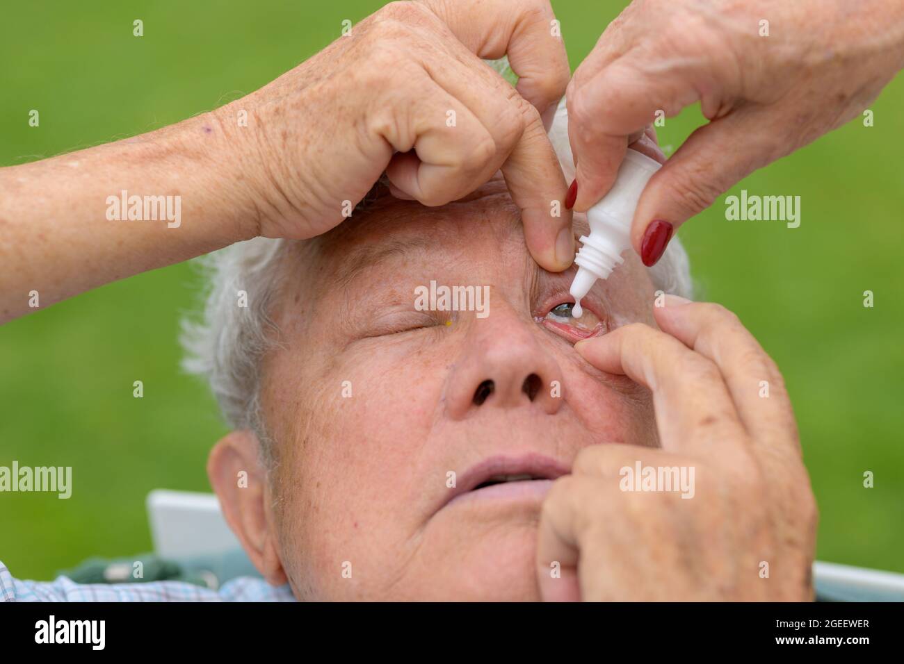 Woman applying eyedrops to the eyes of an elderly man in close up as the drops fall to the lower lid in treatment of an eye disease Stock Photo