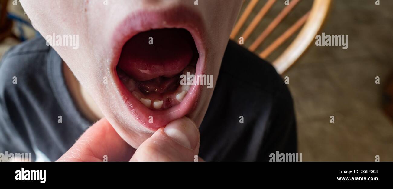 Lower front incisor baby tooth gap showing gums and socket Stock Photo