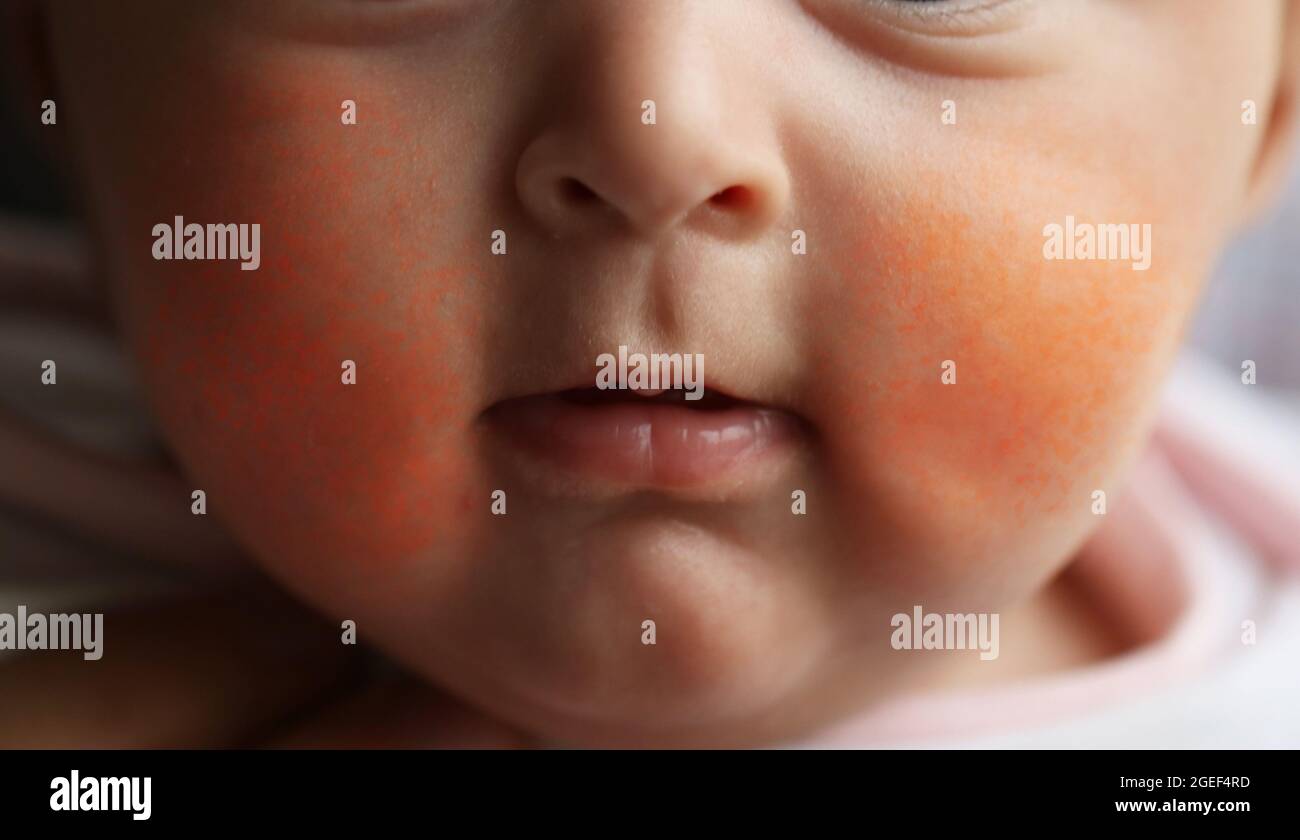 Slapped Cheek Syndrome or Fifth disease Stock Photo