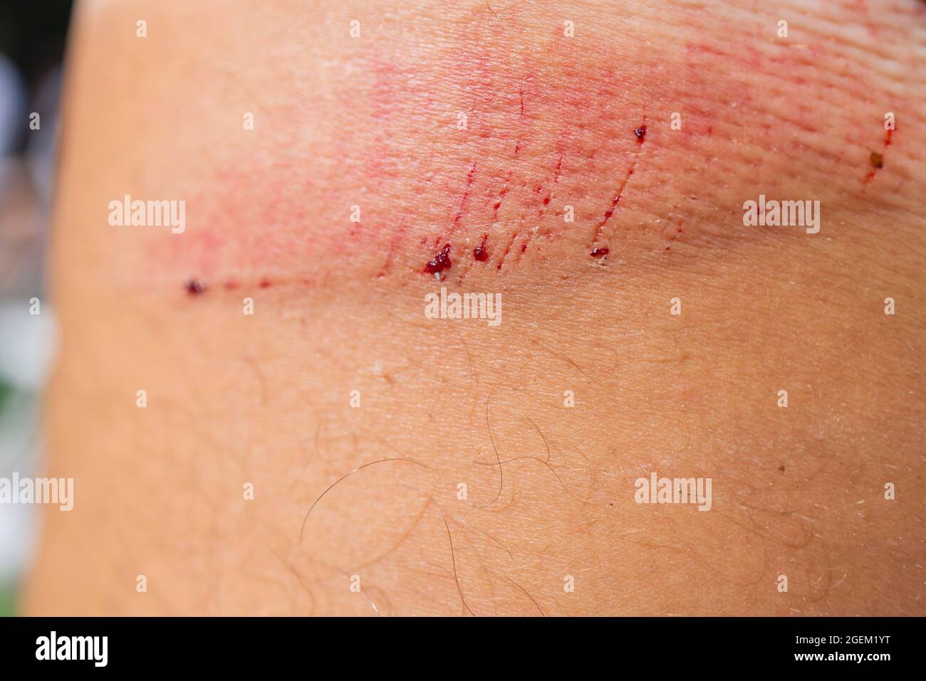 scratch lesion caused by the accident on leg skin Stock Photo Alamy