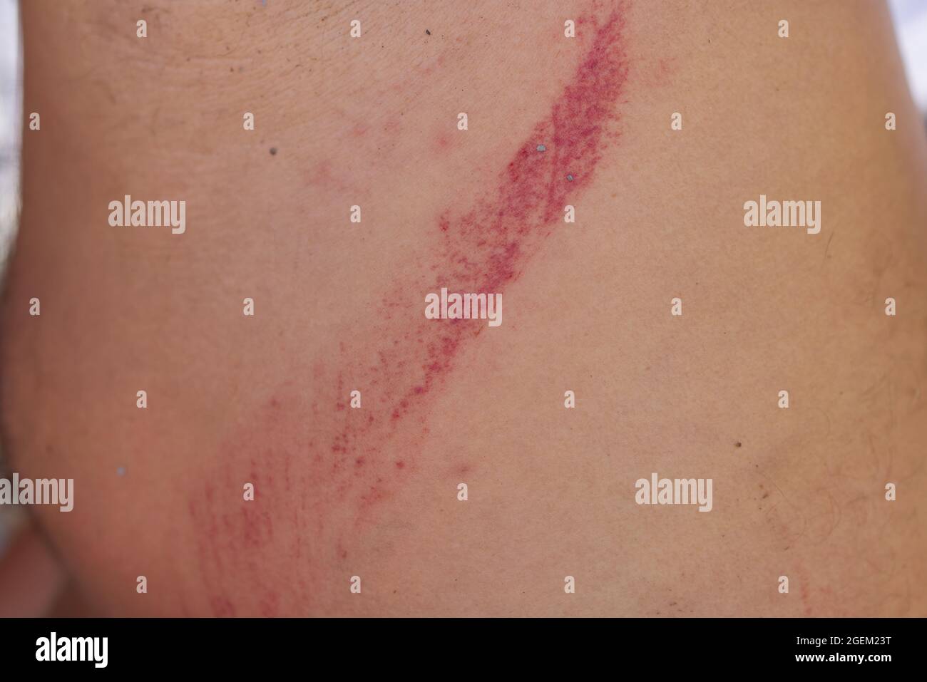scratch lesion caused by the accident on leg skin Stock Photo - Alamy