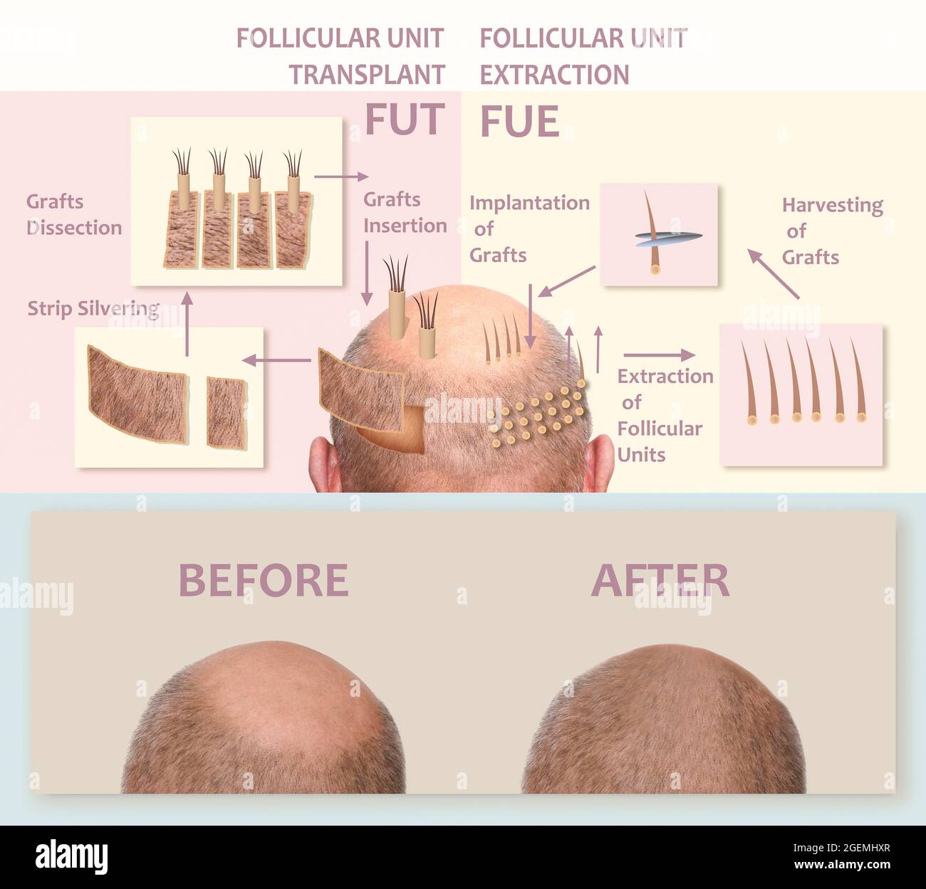 Methods of hair transplantation FUT and FUE fue with transplant as infographic element of illustration. Human alopecia or hair loss problem on adult senior or mature man. Before and after concept Stock Photo
