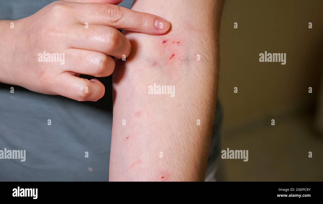Cat Scratch Disease Rash