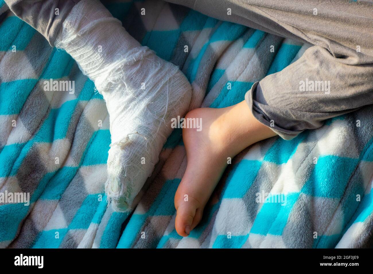 Child with bandage on leg heel fracture. Broken right foot, splint of