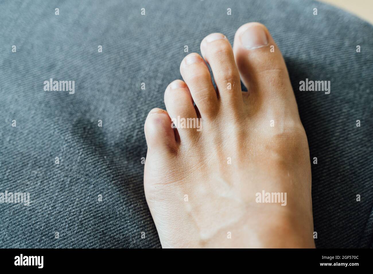 Foot little finger injury. Little toe pain and bruise after home accident. Phalange fracture