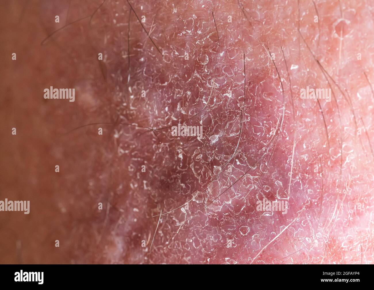 Close-up of bumpy skin with blemishes and scaly epidermis, dermatology and skin diseases. Stock Photo