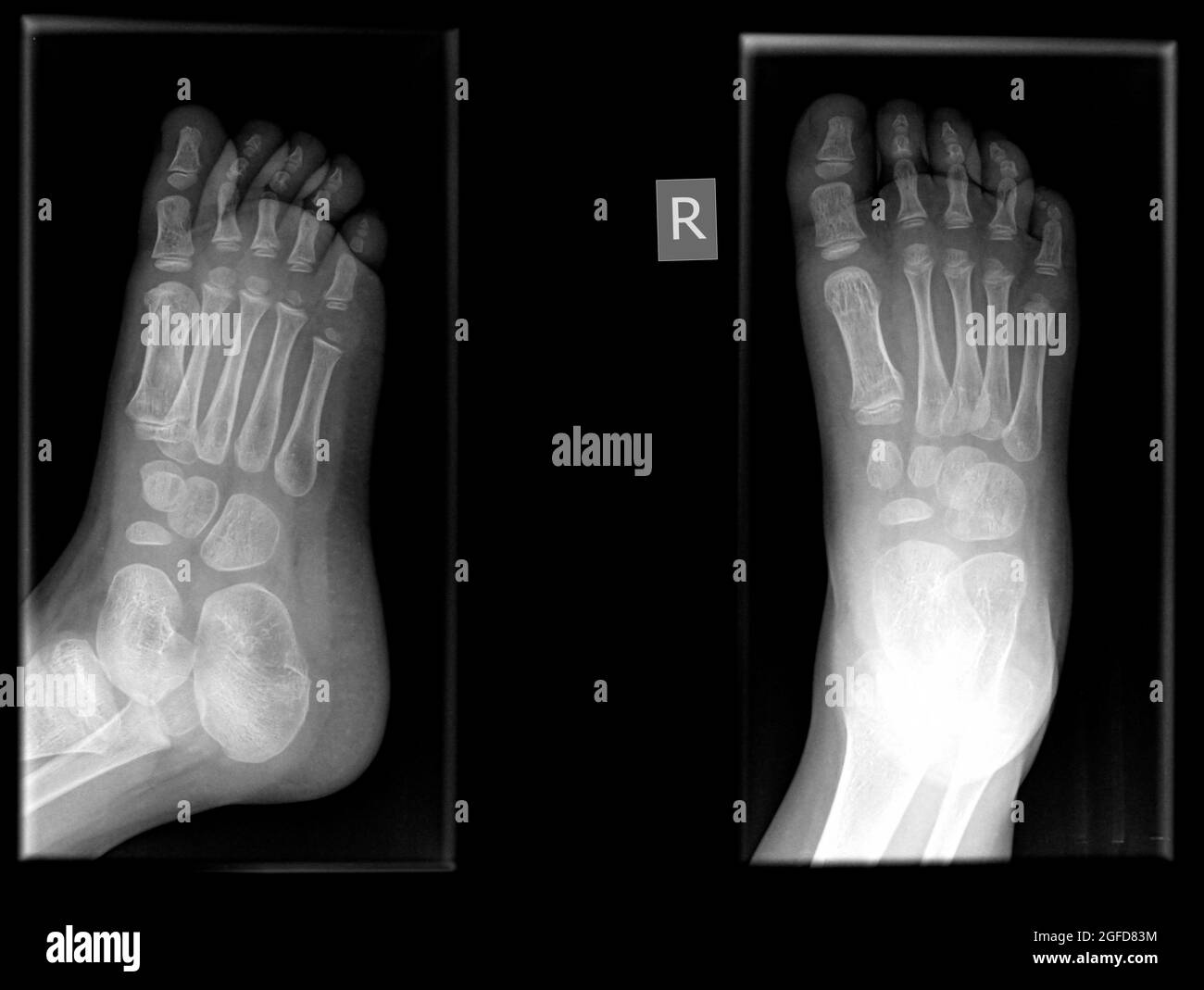 Fracture in the first metatarsal bone of the right foot of a 3 year old male patient Stock Photo